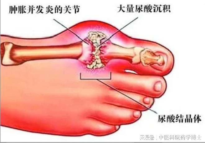 补硒可以治痛风么(治补痛风硒可以吃多久)-硒宝网