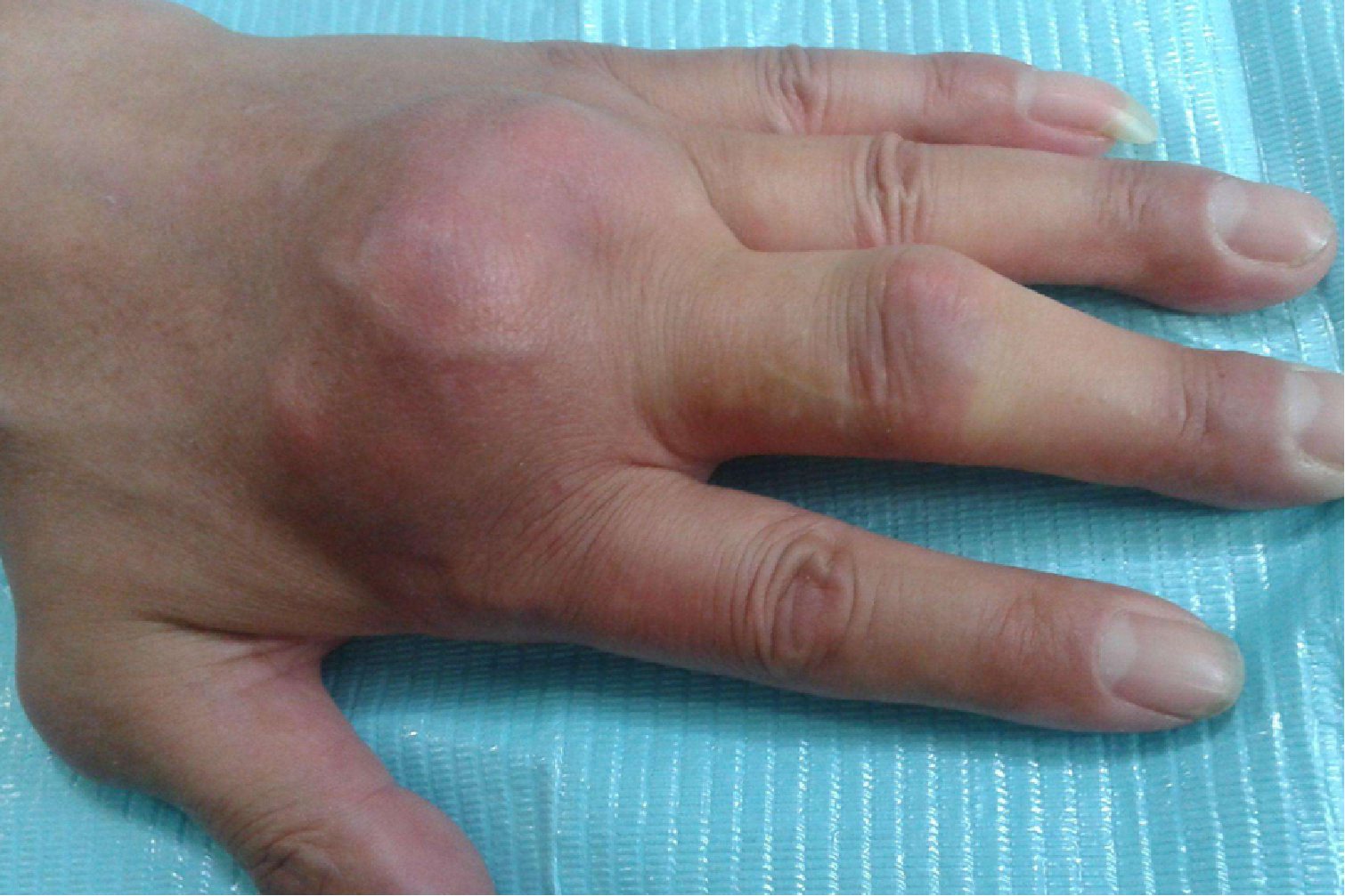 补硒可以治痛风么(治补痛风硒可以吃多久)-硒宝网