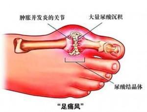 补硒可以降尿酸吗(降补尿酸硒可以停药吗)-硒宝网