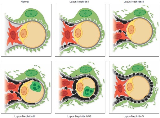 狼疮肾炎可补硒吗(硒对红斑狼疮的作用)-硒宝网