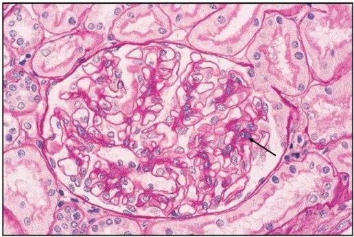 狼疮肾炎可补硒吗(硒对红斑狼疮的作用)-硒宝网
