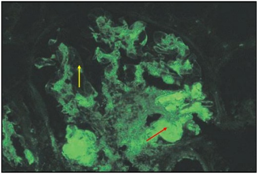 狼疮肾炎可补硒吗(硒对红斑狼疮的作用)-硒宝网