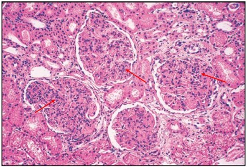 狼疮肾炎可补硒吗(硒对红斑狼疮的作用)-硒宝网