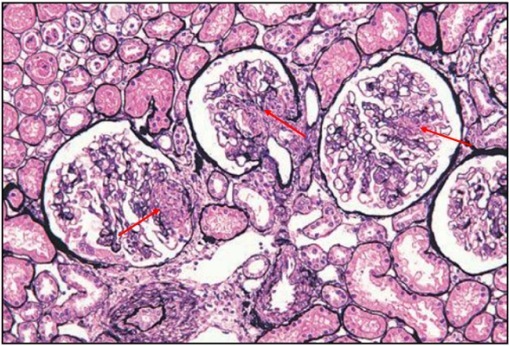 狼疮肾炎可补硒吗(硒对红斑狼疮的作用)-硒宝网