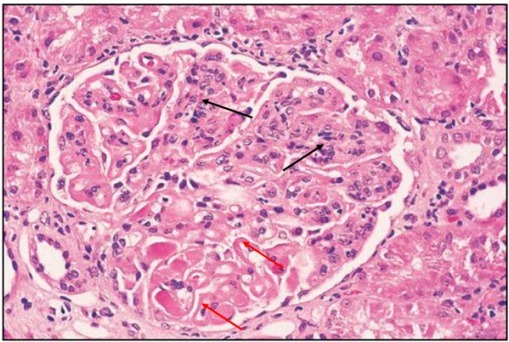 狼疮肾炎可补硒吗(硒对红斑狼疮的作用)-硒宝网