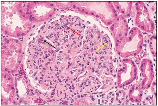狼疮肾炎可补硒吗(硒对红斑狼疮的作用)-硒宝网