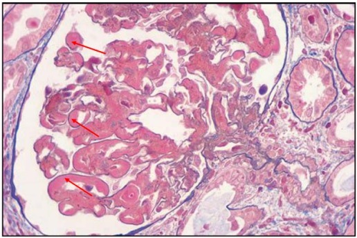 狼疮肾炎可补硒吗(硒对红斑狼疮的作用)-硒宝网