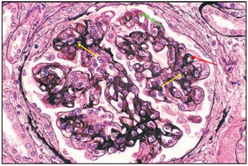 狼疮肾炎可补硒吗(硒对红斑狼疮的作用)-硒宝网