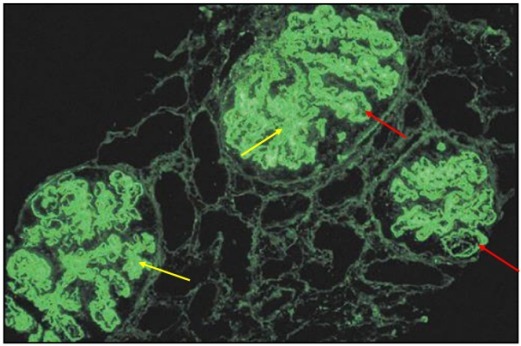 狼疮肾炎可补硒吗(硒对红斑狼疮的作用)-硒宝网