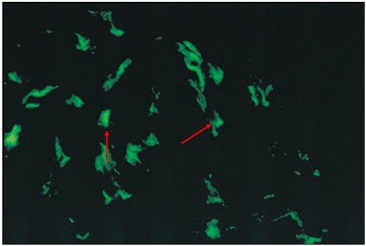 狼疮肾炎可补硒吗(硒对红斑狼疮的作用)-硒宝网