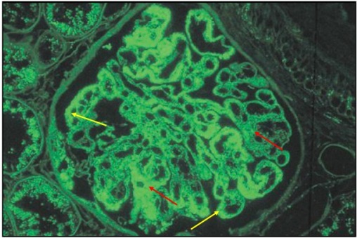 狼疮肾炎可补硒吗(硒对红斑狼疮的作用)-硒宝网