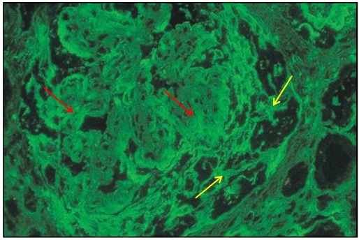 狼疮肾炎可补硒吗(硒对红斑狼疮的作用)-硒宝网