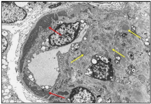 狼疮肾炎可补硒吗(硒对红斑狼疮的作用)-硒宝网