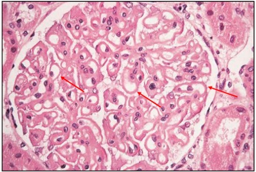 狼疮肾炎可补硒吗(硒对红斑狼疮的作用)-硒宝网