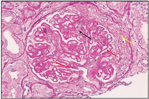 狼疮肾炎可补硒吗(硒对红斑狼疮的作用)-硒宝网