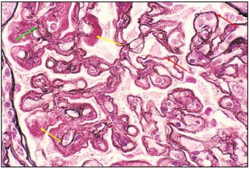 狼疮肾炎可补硒吗(硒对红斑狼疮的作用)-硒宝网