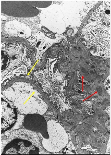 狼疮肾炎可补硒吗(硒对红斑狼疮的作用)-硒宝网