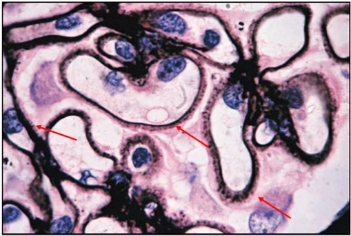 狼疮肾炎可补硒吗(硒对红斑狼疮的作用)-硒宝网