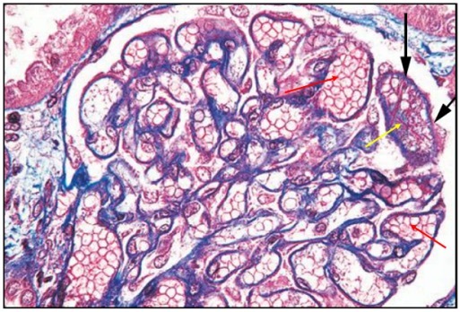 狼疮肾炎可补硒吗(硒对红斑狼疮的作用)-硒宝网