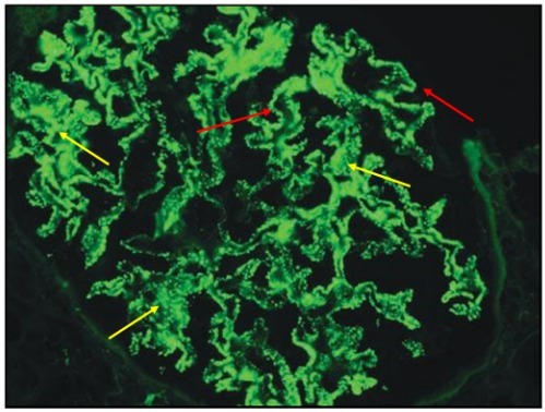 狼疮肾炎可补硒吗(硒对红斑狼疮的作用)-硒宝网