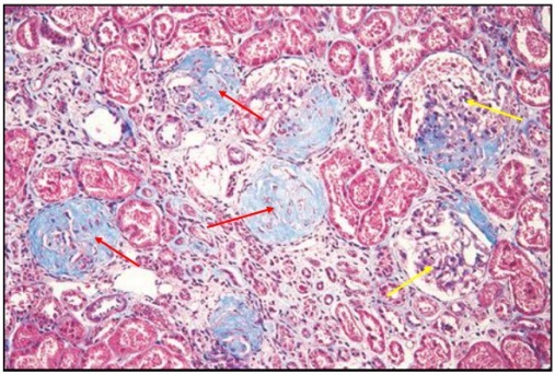 狼疮肾炎可补硒吗(硒对红斑狼疮的作用)-硒宝网