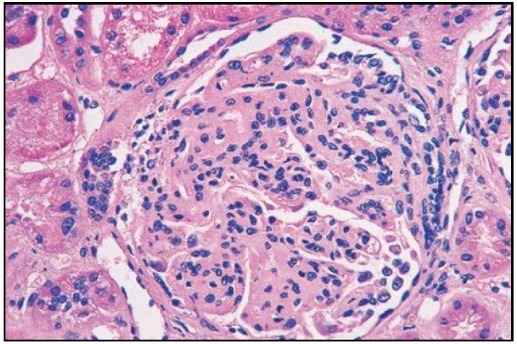 狼疮肾炎可补硒吗(硒对红斑狼疮的作用)-硒宝网