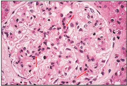 狼疮肾炎可补硒吗(硒对红斑狼疮的作用)-硒宝网