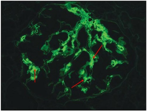 狼疮肾炎可补硒吗(硒对红斑狼疮的作用)-硒宝网