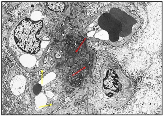 狼疮肾炎可补硒吗(硒对红斑狼疮的作用)-硒宝网