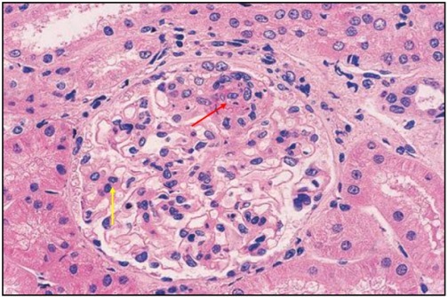 狼疮肾炎可补硒吗(硒对红斑狼疮的作用)-硒宝网