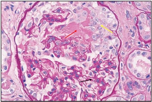 狼疮肾炎可补硒吗(硒对红斑狼疮的作用)-硒宝网