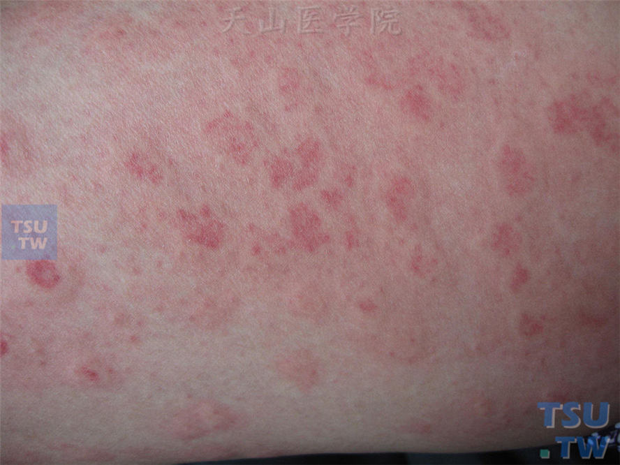 狼疮肾炎可补硒吗(红斑狼疮可以吃硒吗)-硒宝网