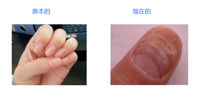 补硒 甲营养不良(甲营养不良补充什么维生素)-硒宝网