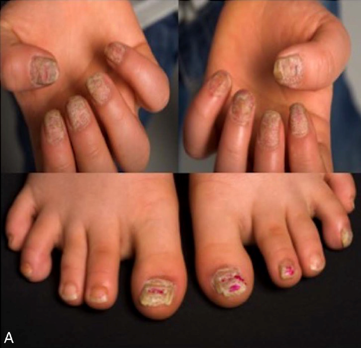 补硒 甲营养不良(甲营养不良补充什么)-硒宝网