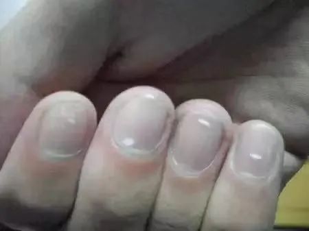 补硒 甲营养不良(甲营养不良补充什么)-硒宝网