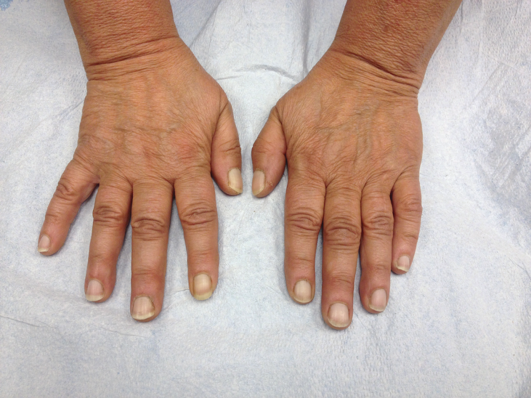 补硒 甲营养不良(甲营养不良补充什么)-硒宝网