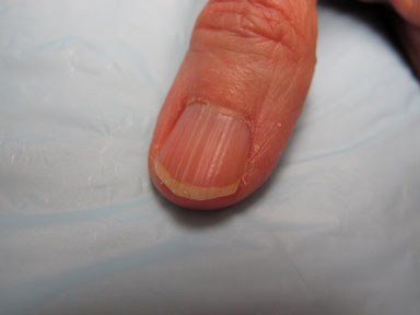 补硒 甲营养不良(甲营养不良补充什么)-硒宝网