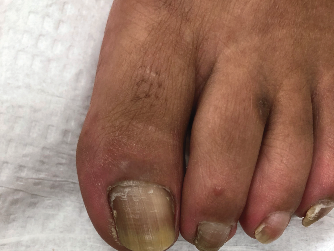 补硒 甲营养不良(甲营养不良补充什么)-硒宝网