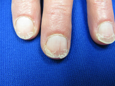 补硒 甲营养不良(甲营养不良补充什么)-硒宝网