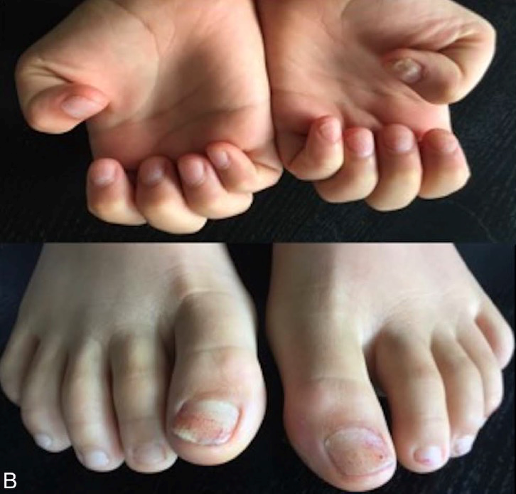 补硒 甲营养不良(甲营养不良补充什么)-硒宝网