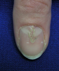 补硒 甲营养不良(甲营养不良补充什么)-硒宝网