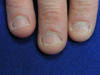 补硒 甲营养不良(甲营养不良补充什么)-硒宝网