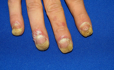 补硒 甲营养不良(甲营养不良补充什么)-硒宝网