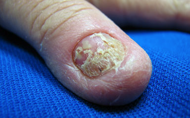 补硒 甲营养不良(甲营养不良补充什么)-硒宝网