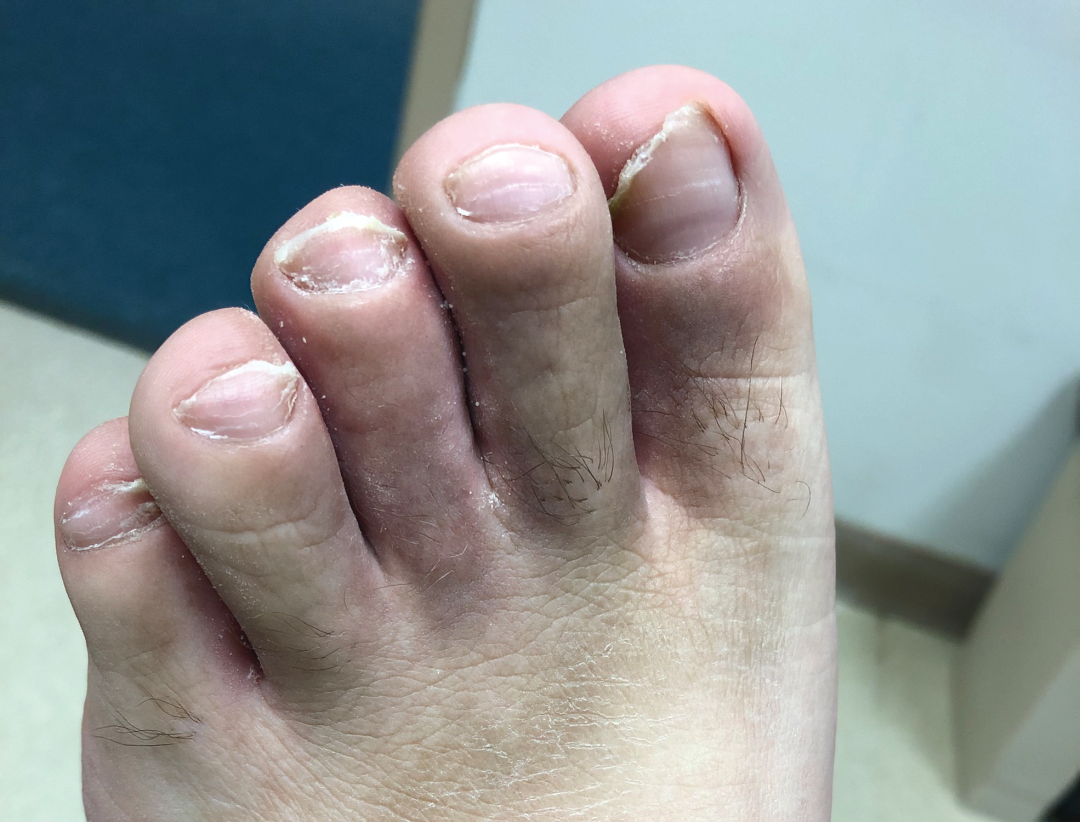 补硒 甲营养不良(甲营养不良补充什么)-硒宝网