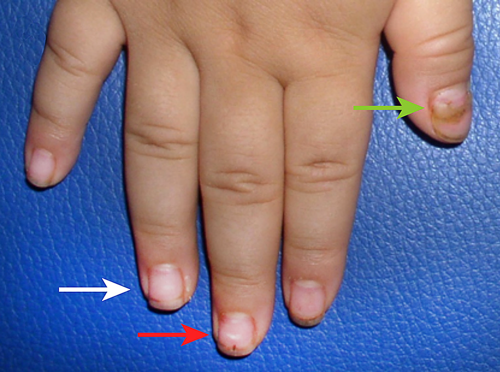 补硒 甲营养不良(甲营养不良补充什么)-硒宝网