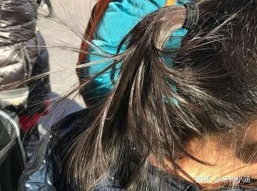 吃补硒胶囊脱头发(脱发补硒)-硒宝网