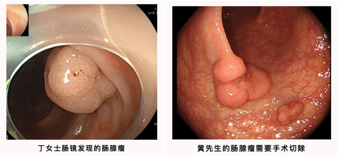 补硒能预防息肉吗(硒对息肉有没有作用)-硒宝网