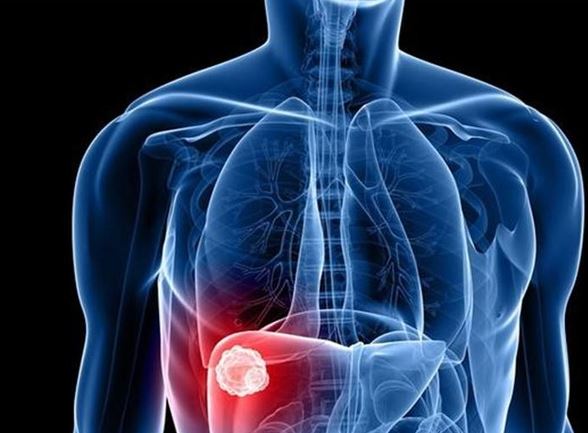 肝癌补硒会浮肿吗(肝癌补硒多长时间能恢复肝功能)-硒宝网