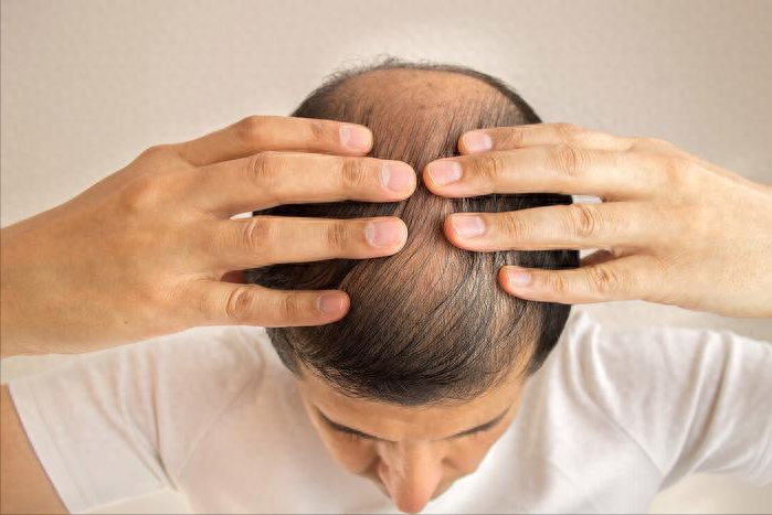 补硒多了会掉发吗（补硒后头发不怎么掉了）-硒宝网